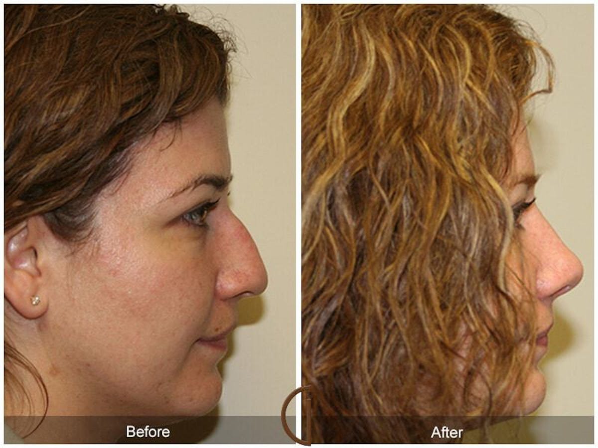 Female Rhinoplasty Before & After Gallery - Patient 283123 - Image 3