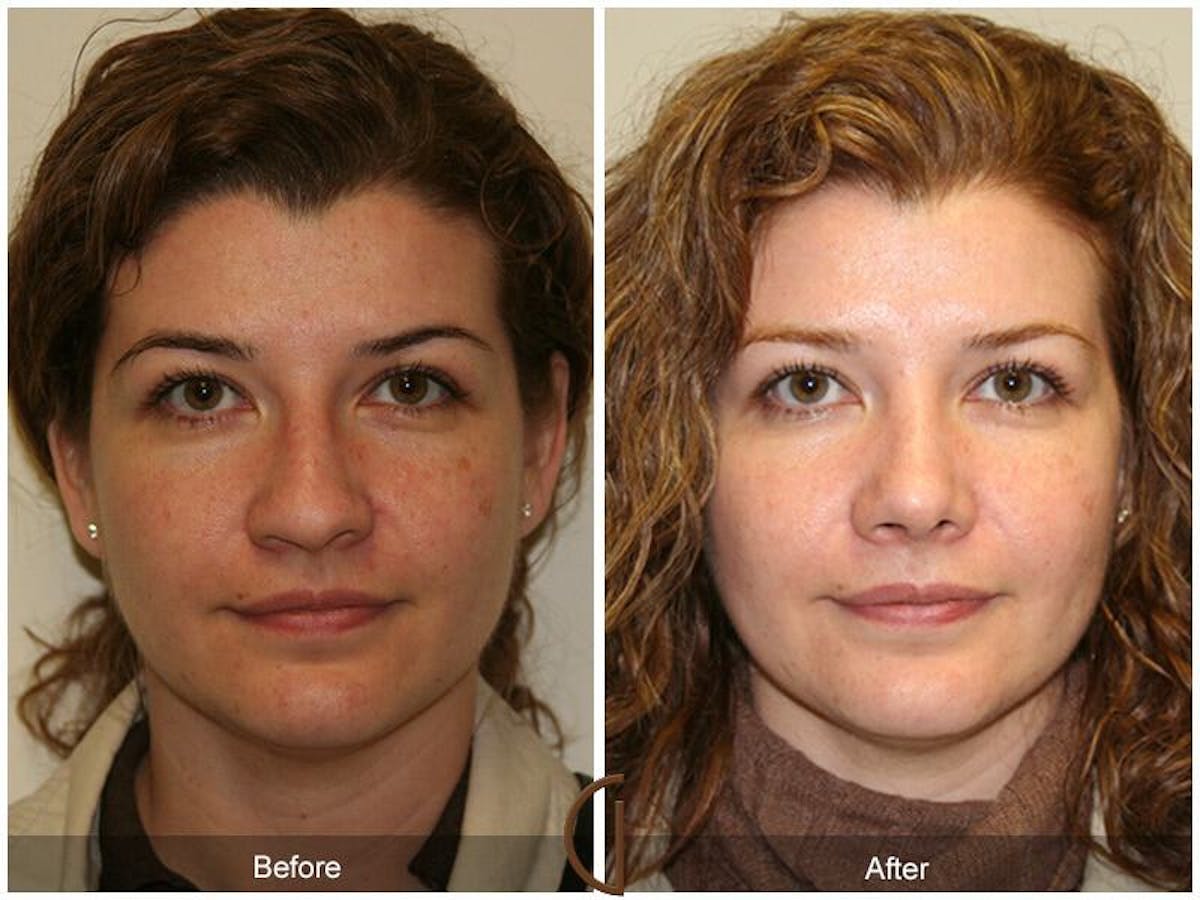Female Rhinoplasty Before & After Gallery - Patient 283123 - Image 2
