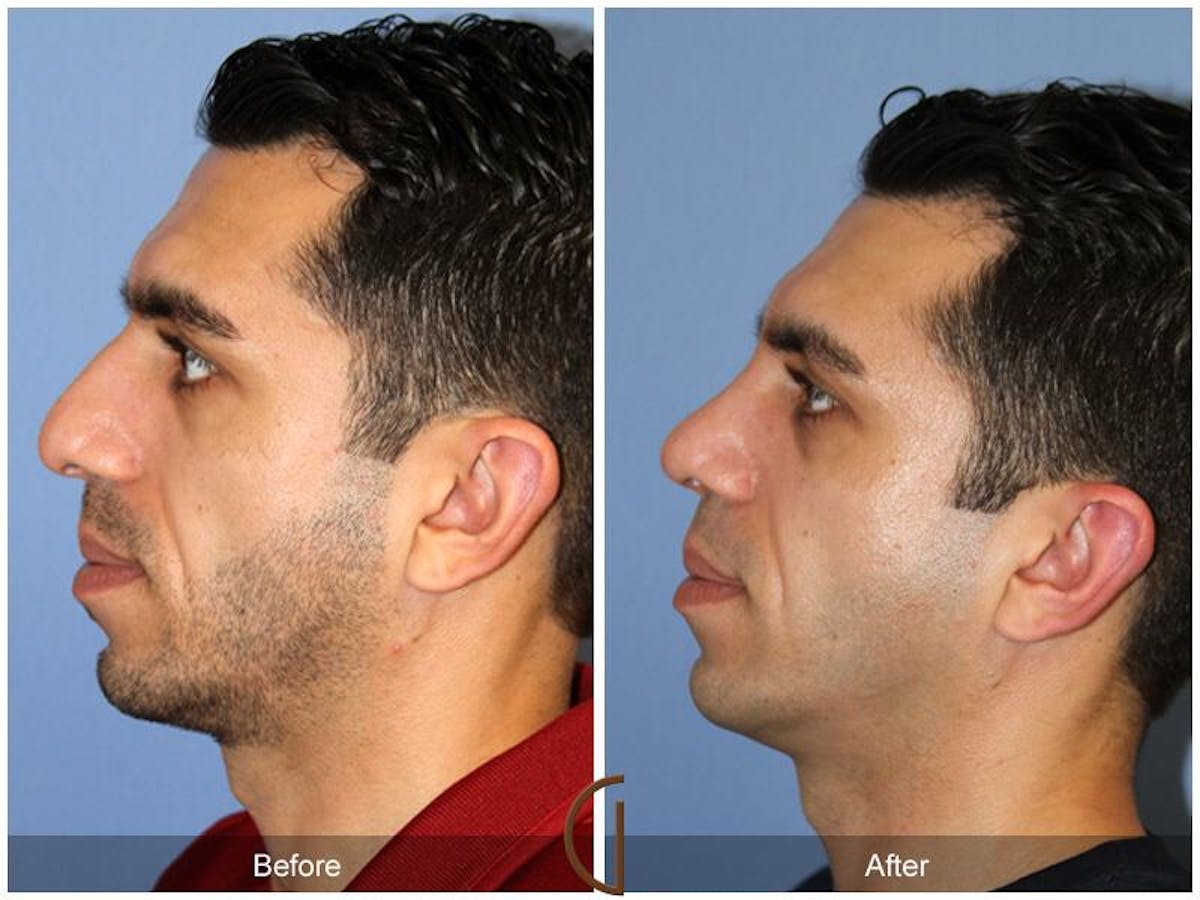 Male Rhinoplasty Before & After Gallery - Patient 220223 - Image 1