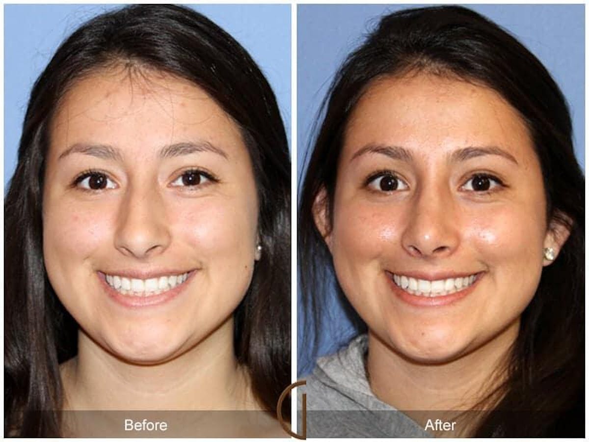 Ethnic Rhinoplasty Before & After Gallery - Patient 679260 - Image 2