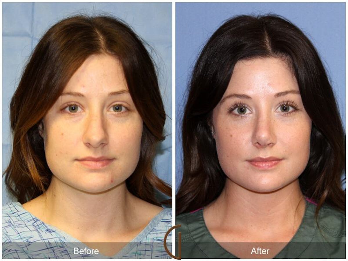 Female Rhinoplasty Before & After Gallery - Patient 334082 - Image 2