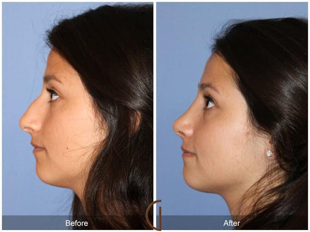 Ethnic Rhinoplasty Before & After Gallery - Patient 679260 - Image 1