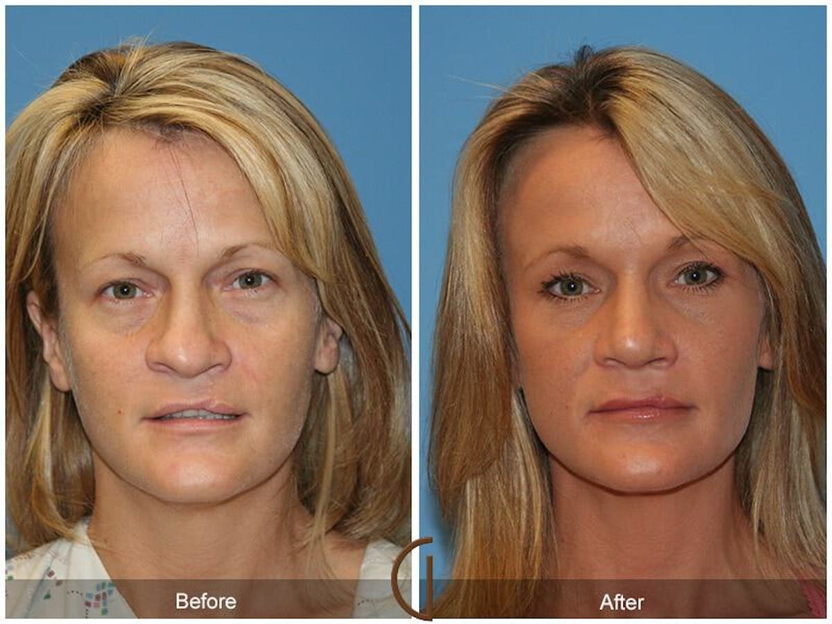 Revision Rhinoplasty Before & After Gallery - Patient 388884 - Image 2
