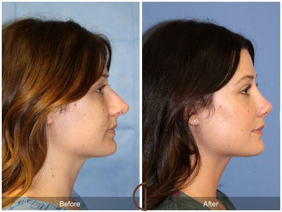 Female Rhinoplasty Before & After Gallery - Patient 334082 - Image 3