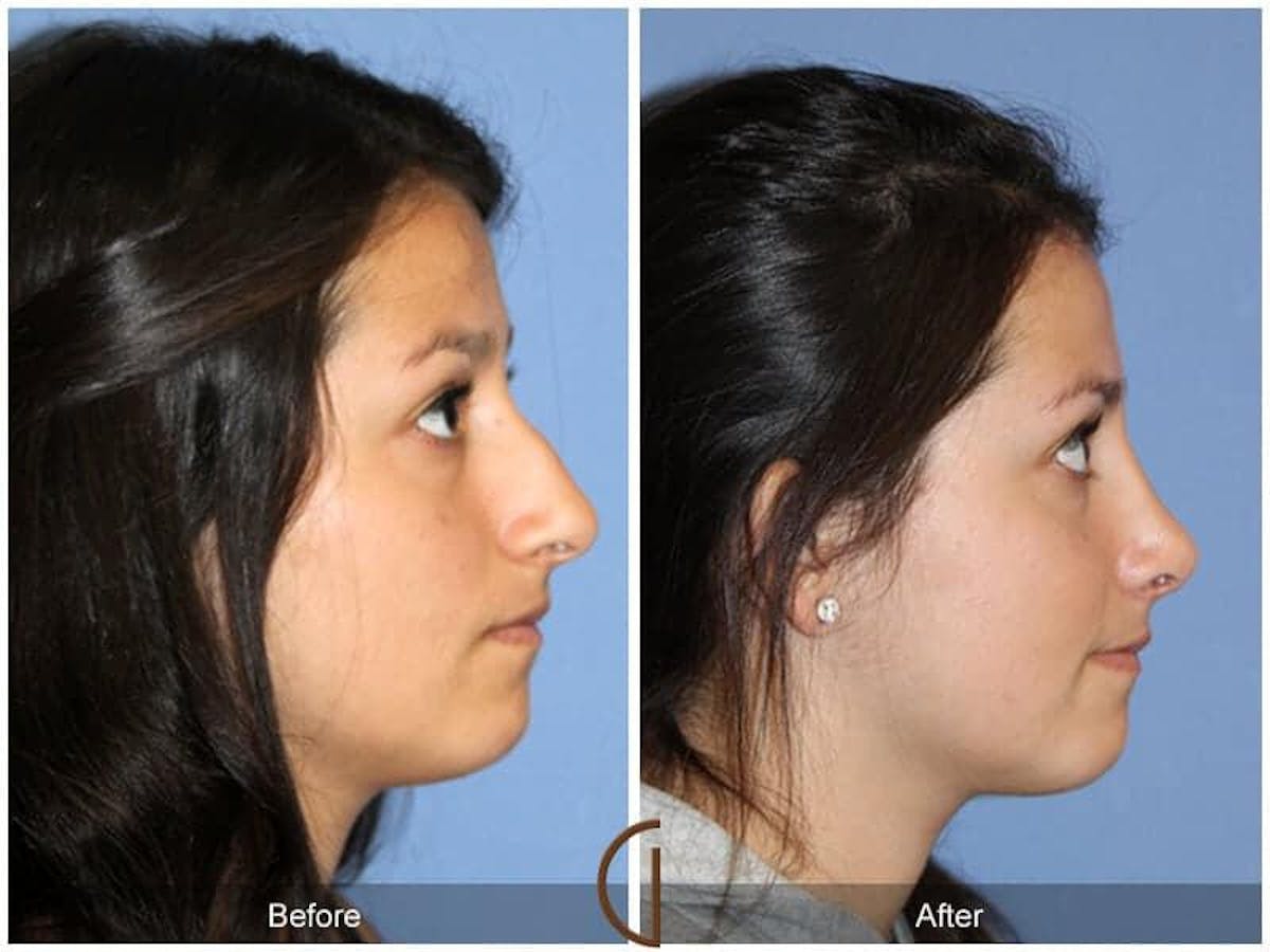 Ethnic Rhinoplasty Before & After Gallery - Patient 679260 - Image 3