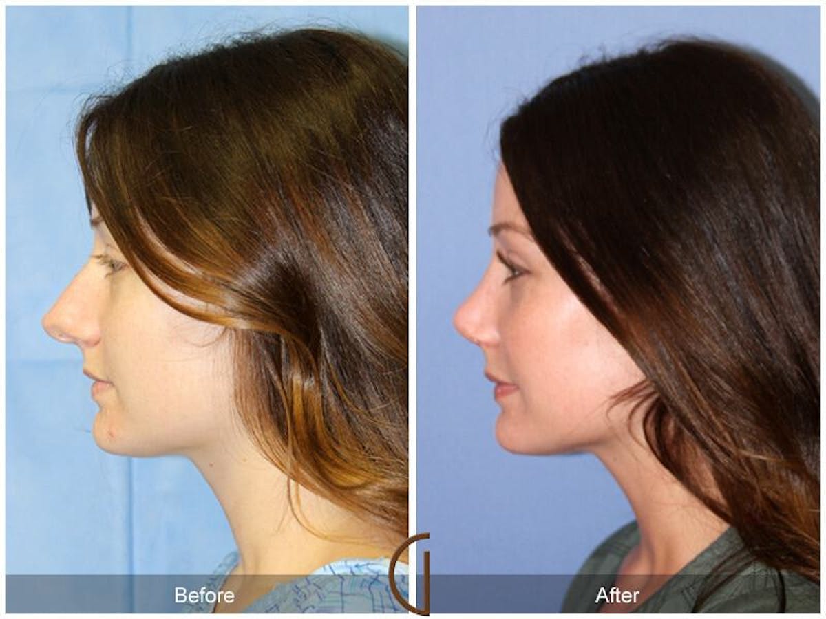 Female Rhinoplasty Before & After Gallery - Patient 334082 - Image 1