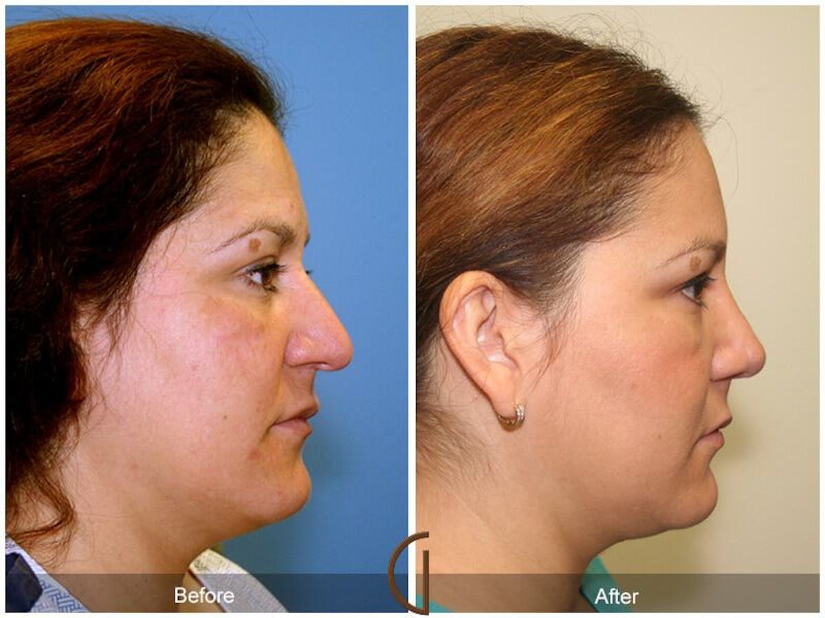 Female Rhinoplasty Before & After Gallery - Patient 170072 - Image 3