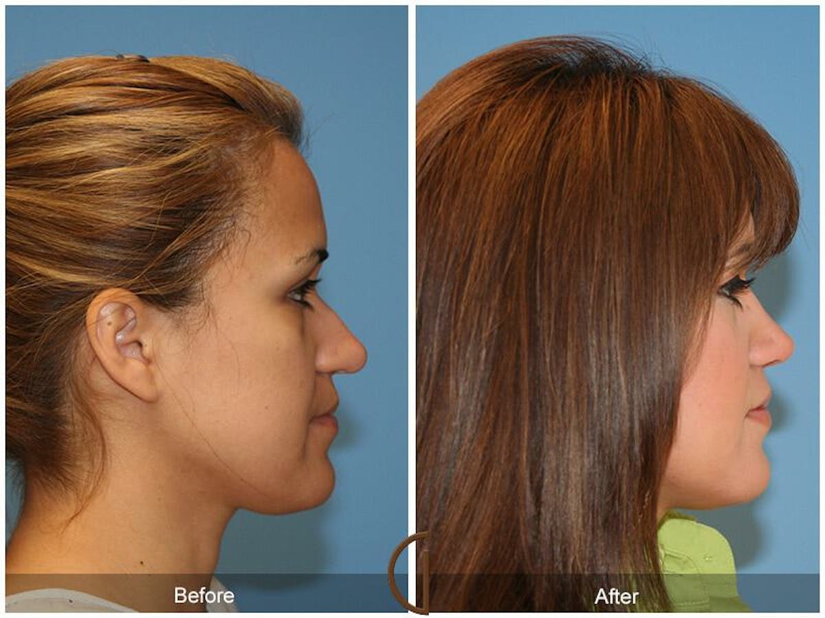 Female Rhinoplasty Before & After Gallery - Patient 172894 - Image 3