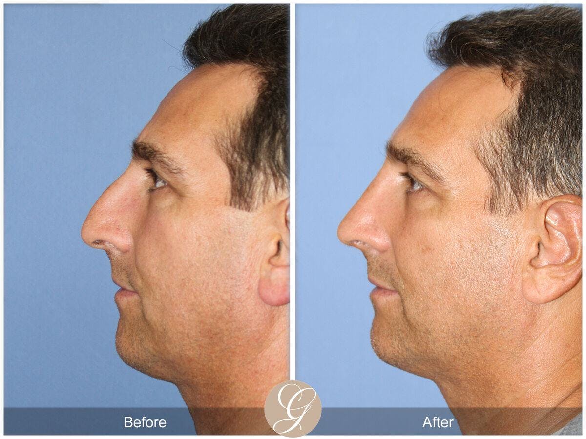 Male Rhinoplasty Before & After Gallery - Patient 393786 - Image 1