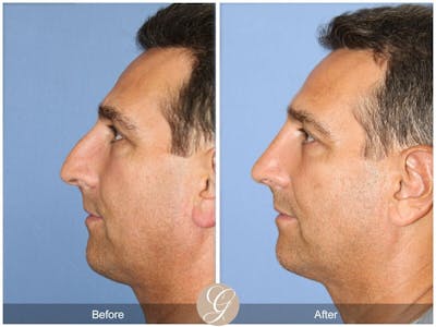 Male Rhinoplasty Before & After Gallery - Patient 393786 - Image 1