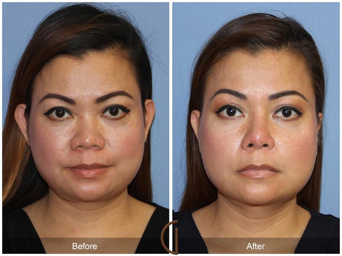 Female Rhinoplasty Before & After Gallery - Patient 268967 - Image 2