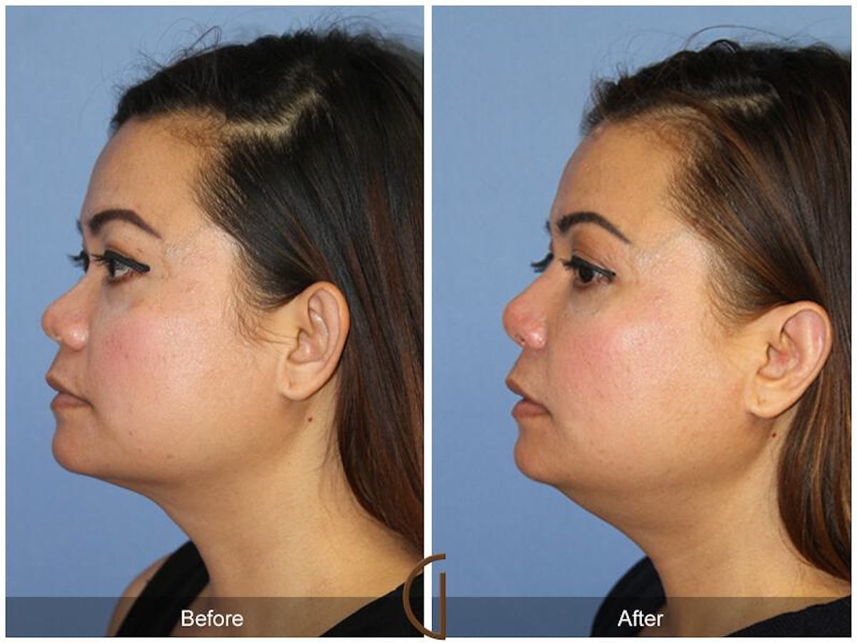 Female Rhinoplasty Before & After Gallery - Patient 268967 - Image 1