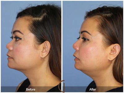 Female Rhinoplasty Before & After Gallery - Patient 268967 - Image 1