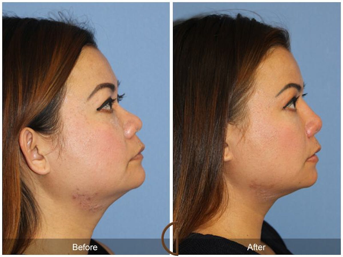 Female Rhinoplasty Before & After Gallery - Patient 268967 - Image 3