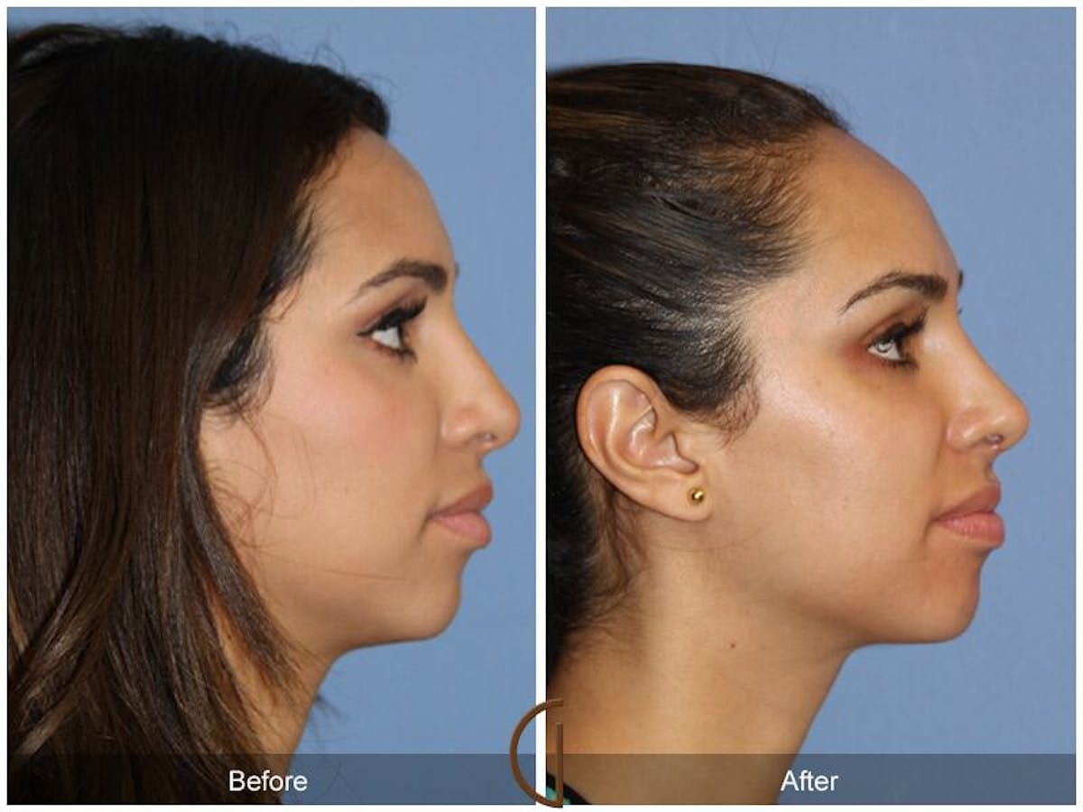 Female Rhinoplasty Before & After Gallery - Patient 171077 - Image 3