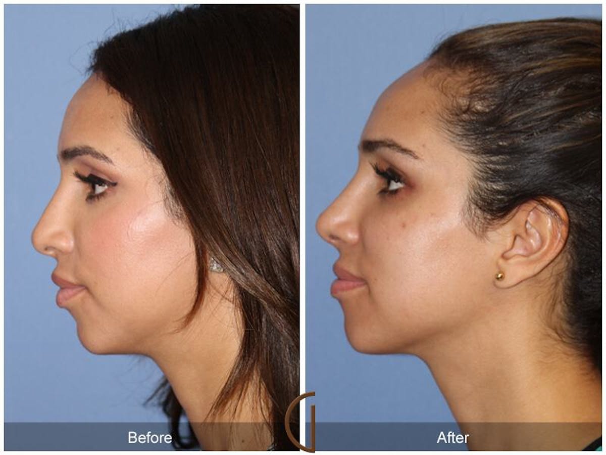 Female Rhinoplasty Before & After Gallery - Patient 171077 - Image 1