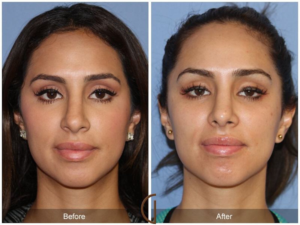 Female Rhinoplasty Before & After Gallery - Patient 171077 - Image 2