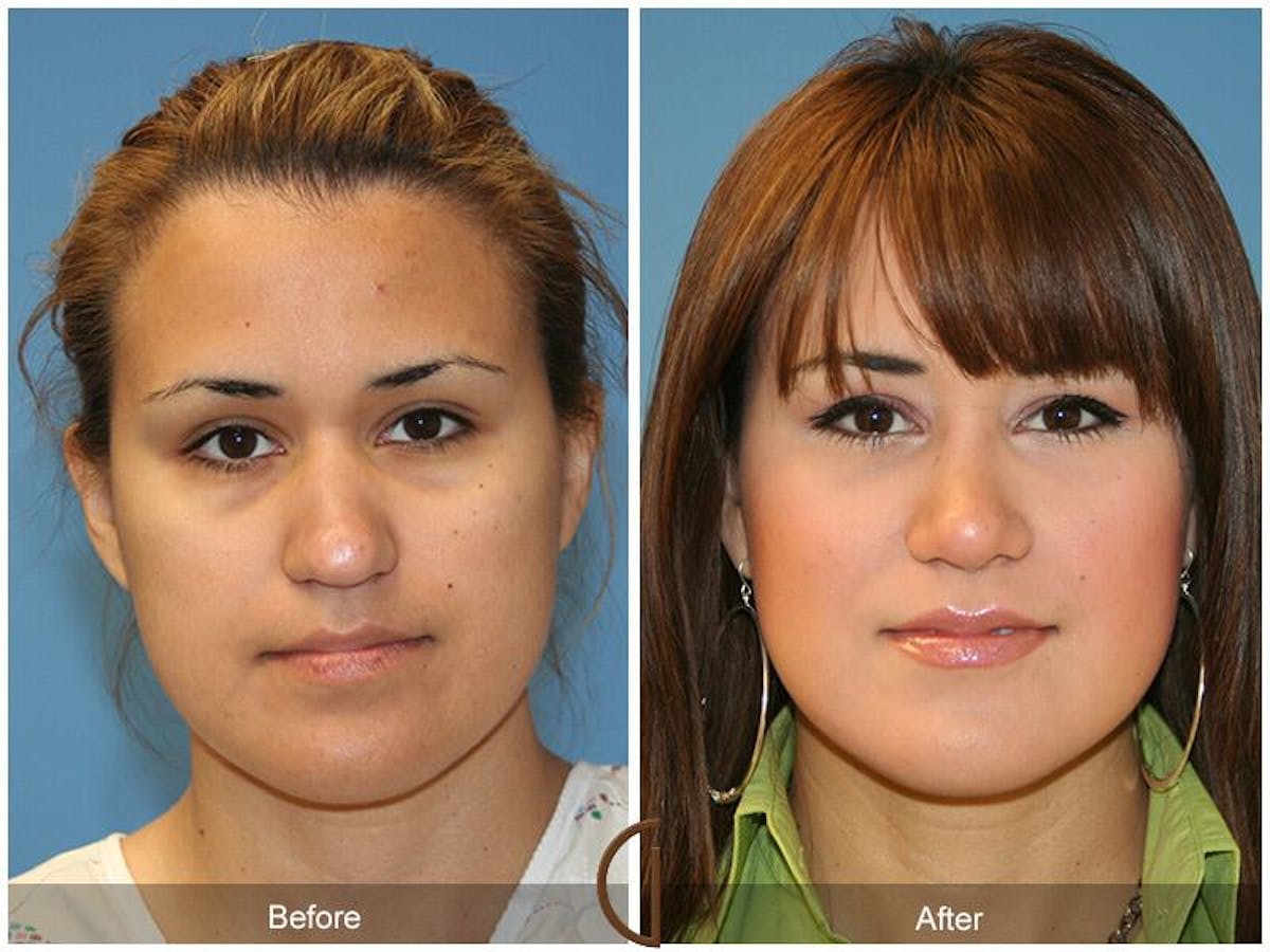Female Rhinoplasty Before & After Gallery - Patient 172894 - Image 2