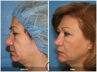 Female Rhinoplasty Before & After Gallery - Patient 101728 - Image 1