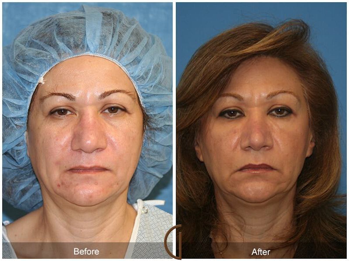 Female Rhinoplasty Before & After Gallery - Patient 101728 - Image 2