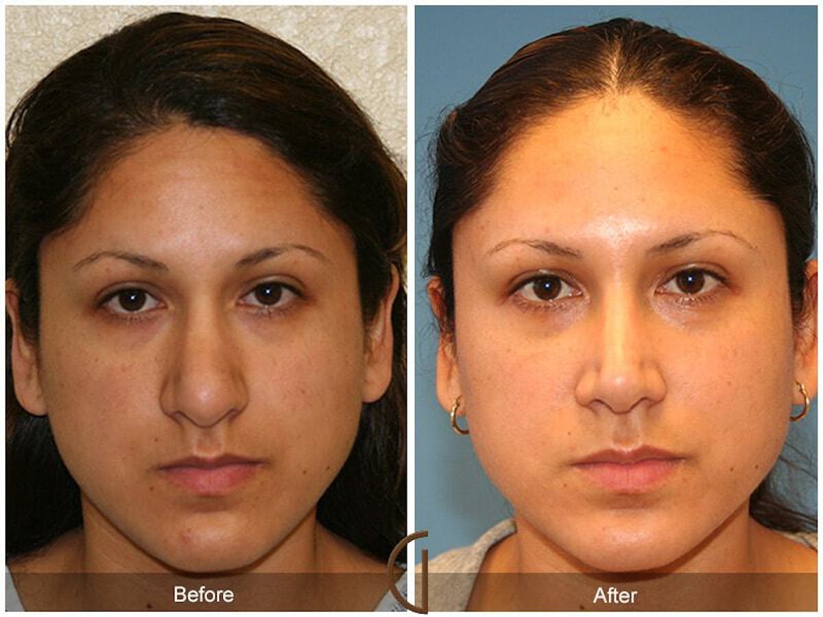 Revision Rhinoplasty Before & After Gallery - Patient 427379 - Image 2