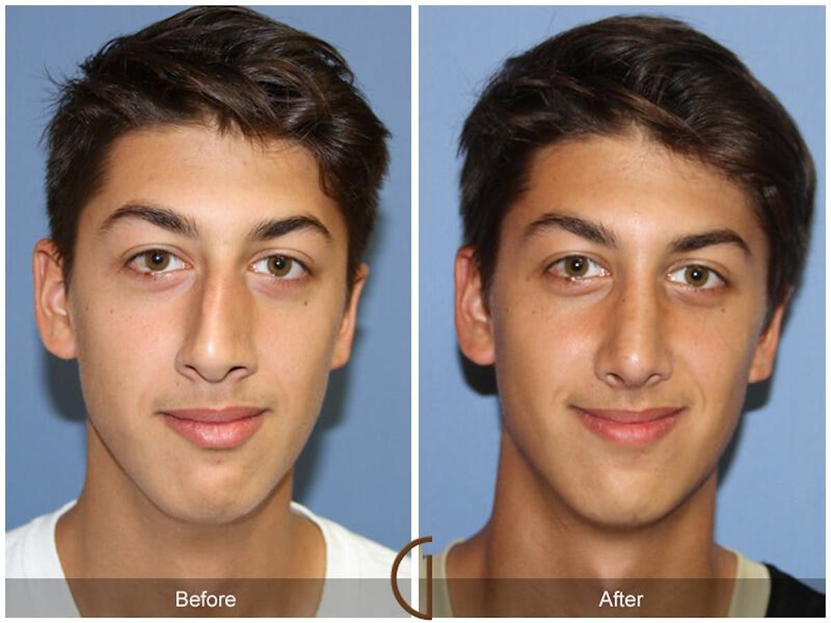 Rhinoplasty Before & After Gallery - Patient 102916 - Image 2