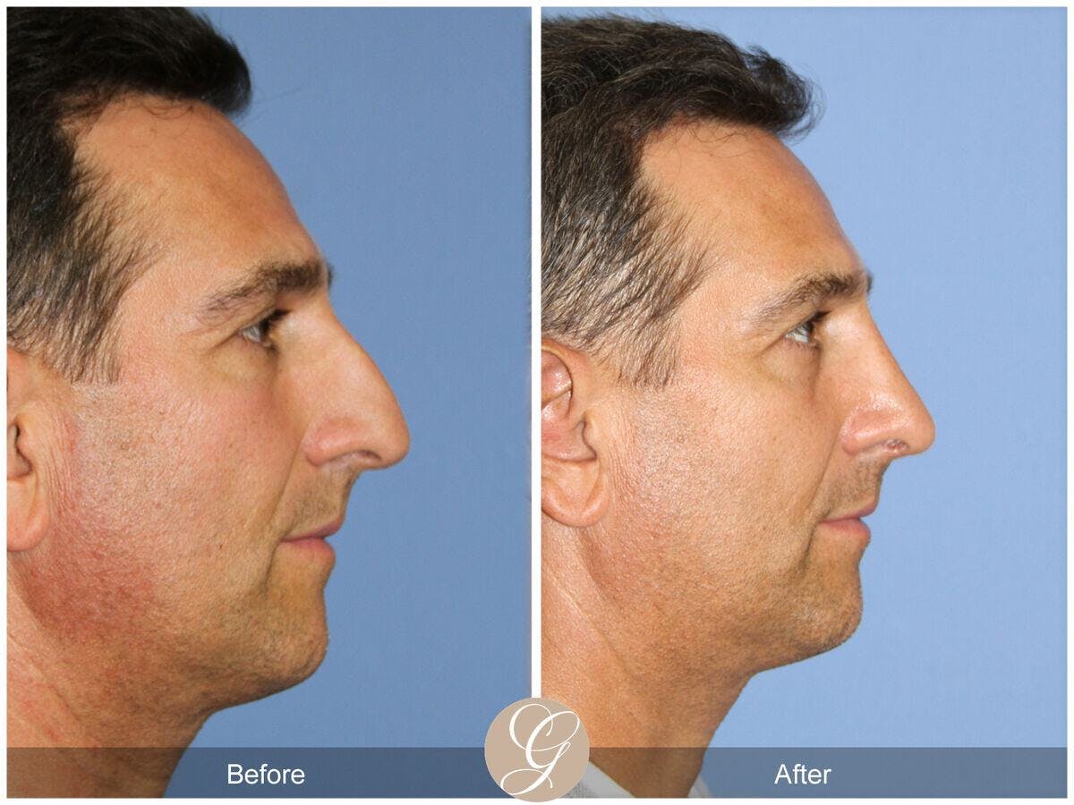 Male Rhinoplasty Before & After Gallery - Patient 393786 - Image 3