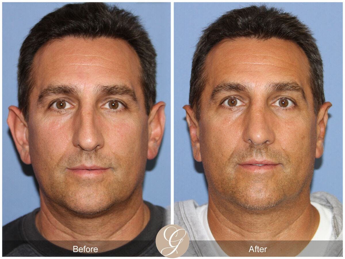 Male Rhinoplasty Before & After Gallery - Patient 393786 - Image 2