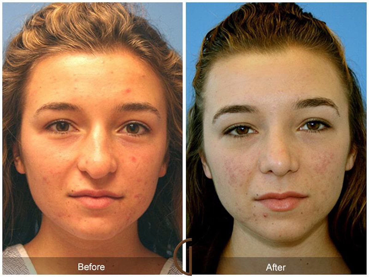 Female Rhinoplasty Before & After Gallery - Patient 878687 - Image 2
