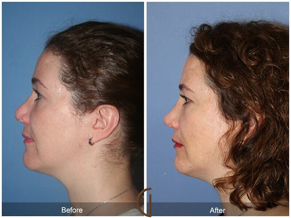 Revision Rhinoplasty Before & After Gallery - Patient 664722 - Image 1
