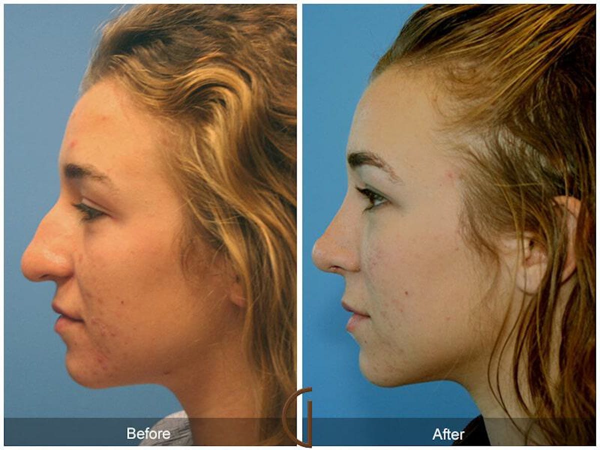 Female Rhinoplasty Before & After Gallery - Patient 878687 - Image 1