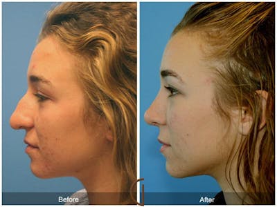 Female Rhinoplasty Before & After Gallery - Patient 878687 - Image 1
