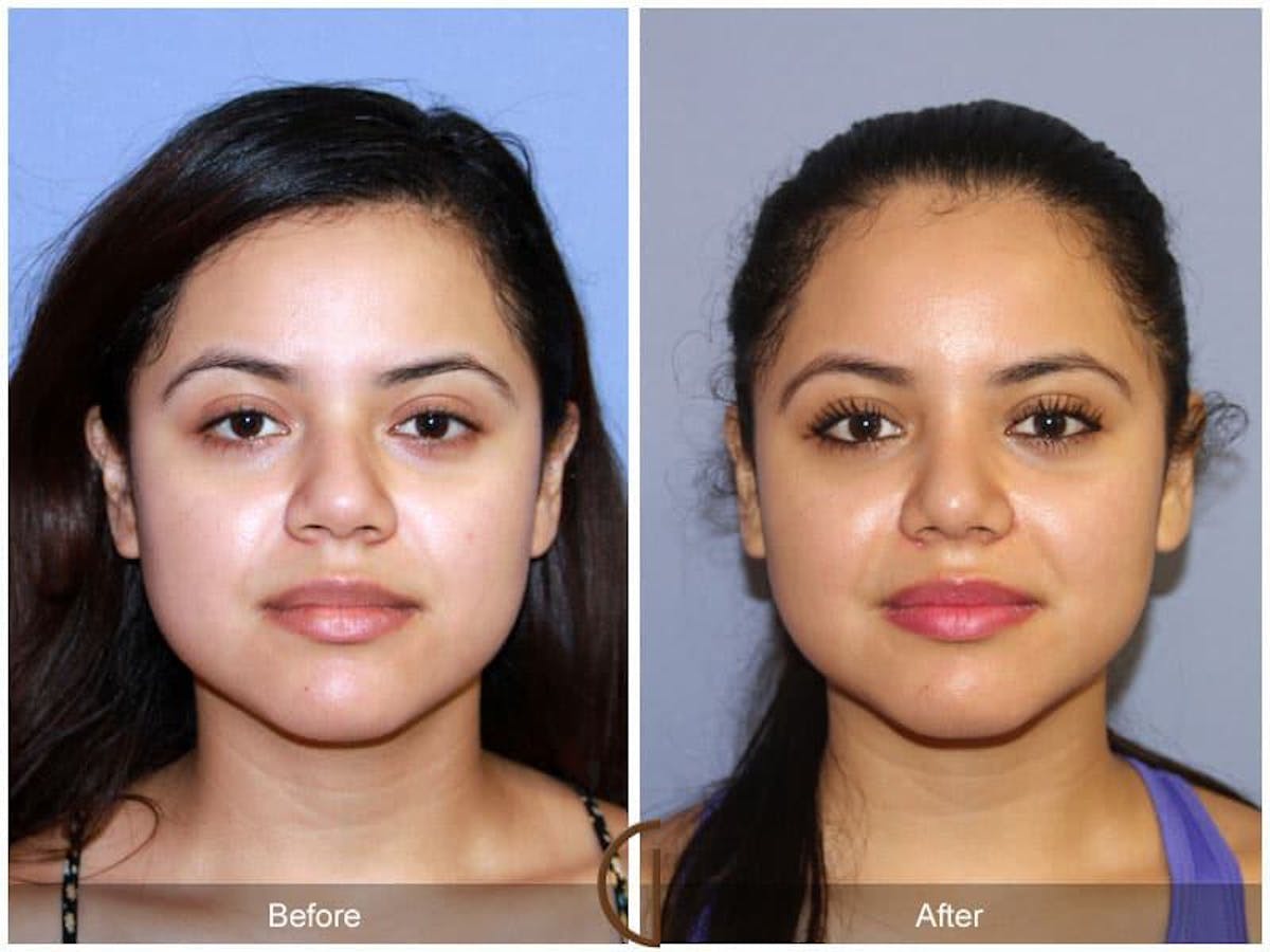 Rhinoplasty Before & After Gallery - Patient 390772 - Image 2