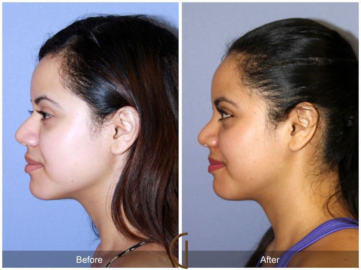 Rhinoplasty Before & After Gallery - Patient 390772 - Image 1