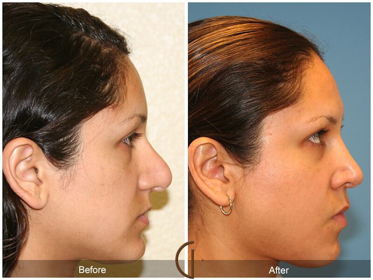 Revision Rhinoplasty Before & After Gallery - Patient 427379 - Image 3