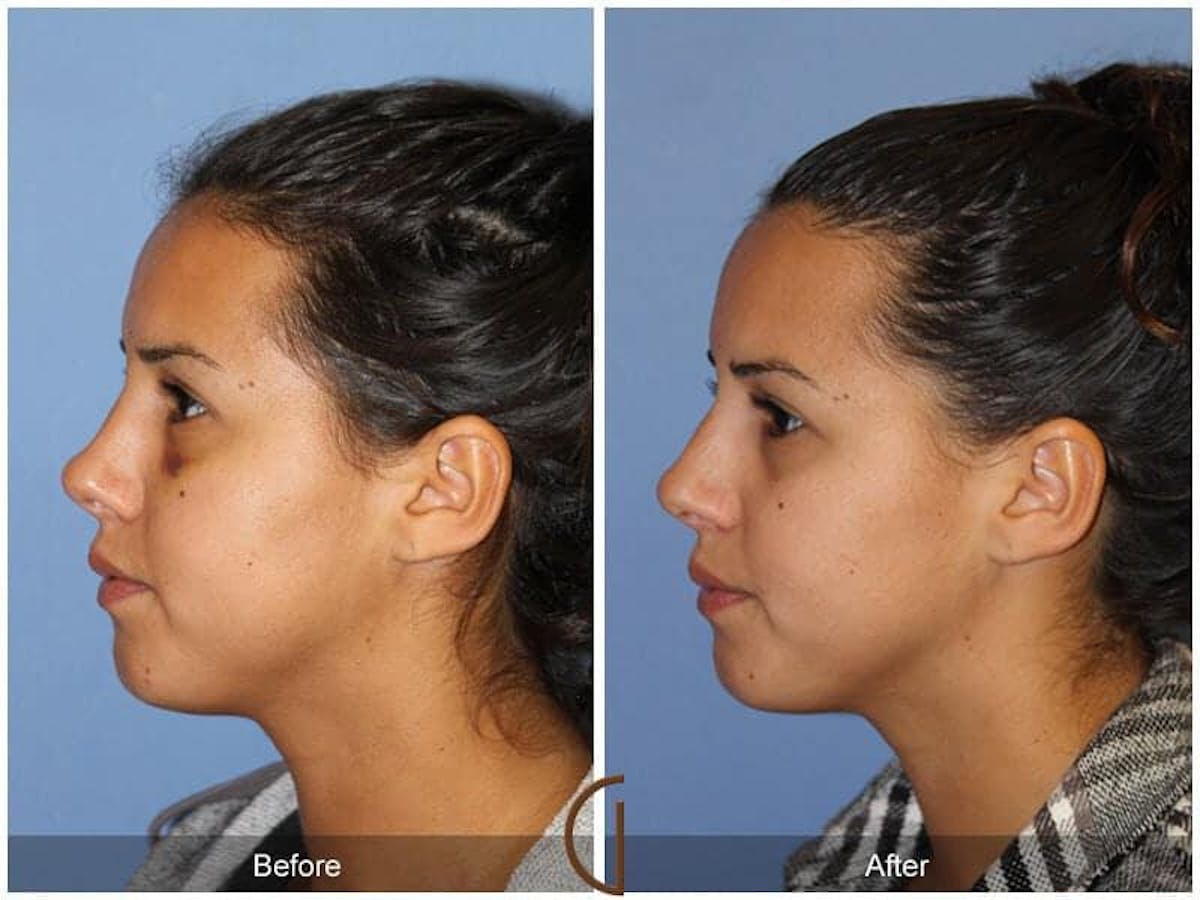 Revision Rhinoplasty Before & After Gallery - Patient 718744 - Image 1