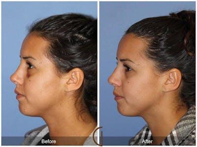Revision Rhinoplasty Before & After Gallery - Patient 718744 - Image 1