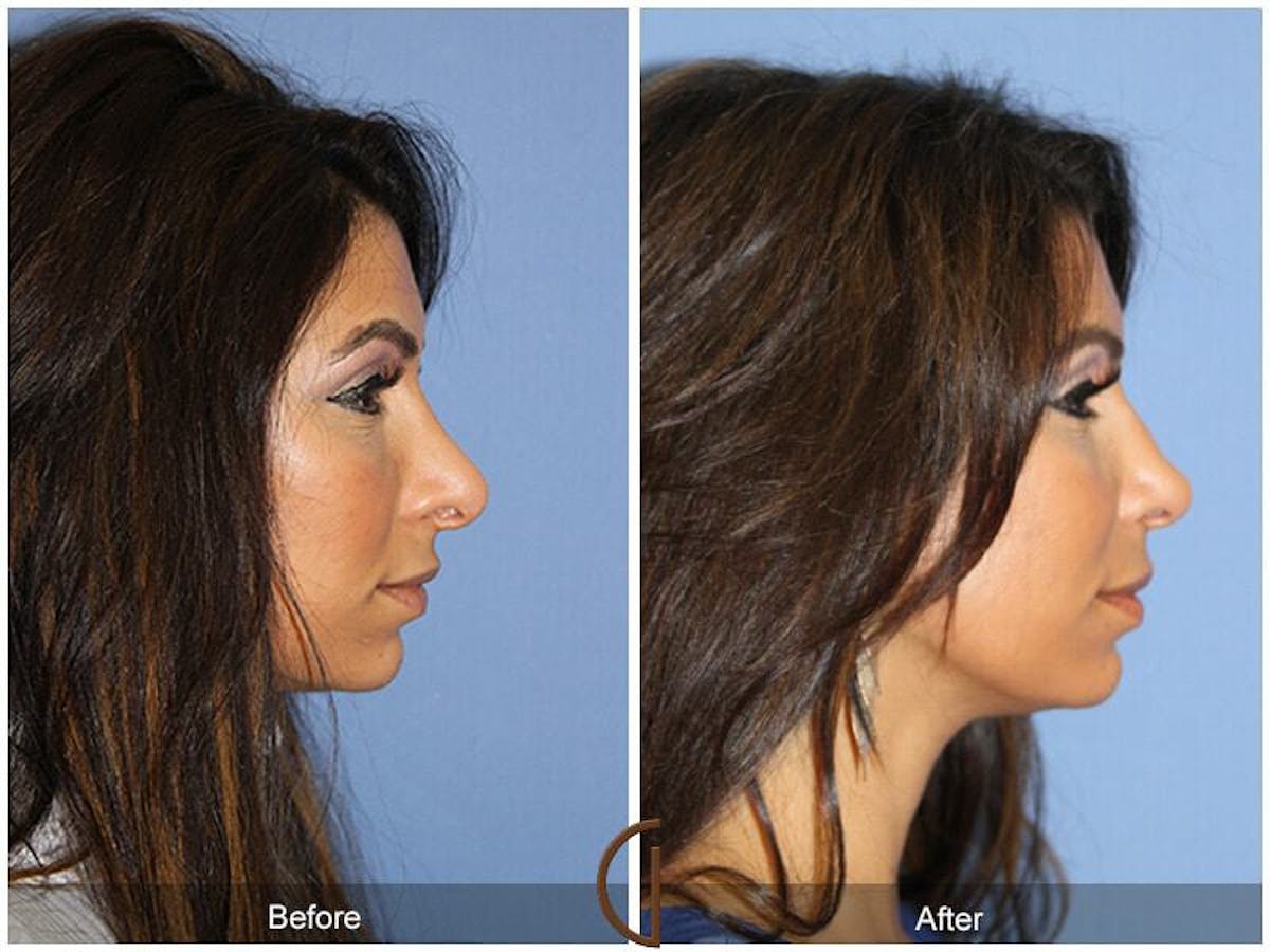 Ethnic Rhinoplasty Before & After Gallery - Patient 369106 - Image 3