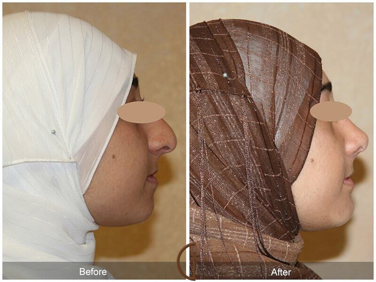 Ethnic Rhinoplasty Before & After Gallery - Patient 364518 - Image 3