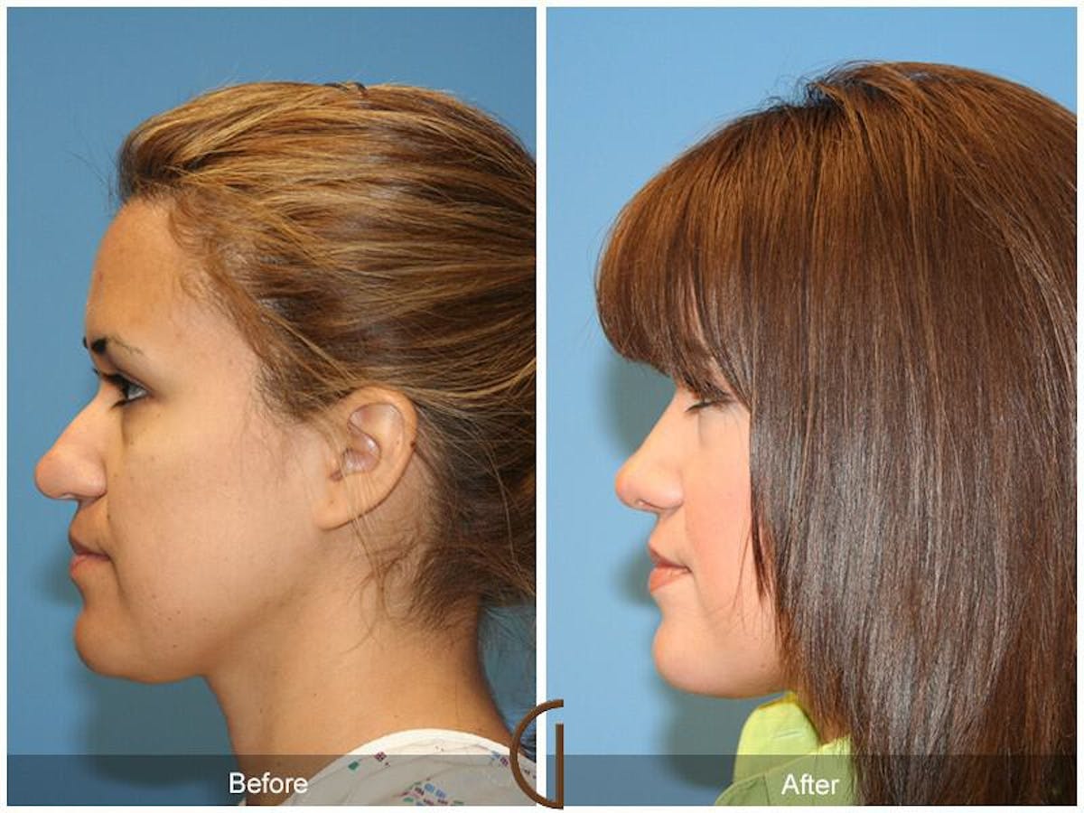 Ethnic Rhinoplasty Before & After Gallery - Patient 798047 - Image 1