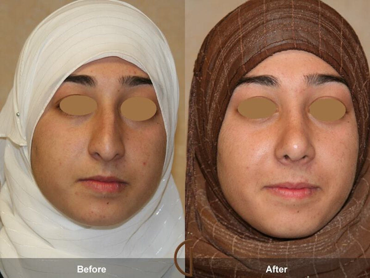 Ethnic Rhinoplasty Before & After Gallery - Patient 364518 - Image 2