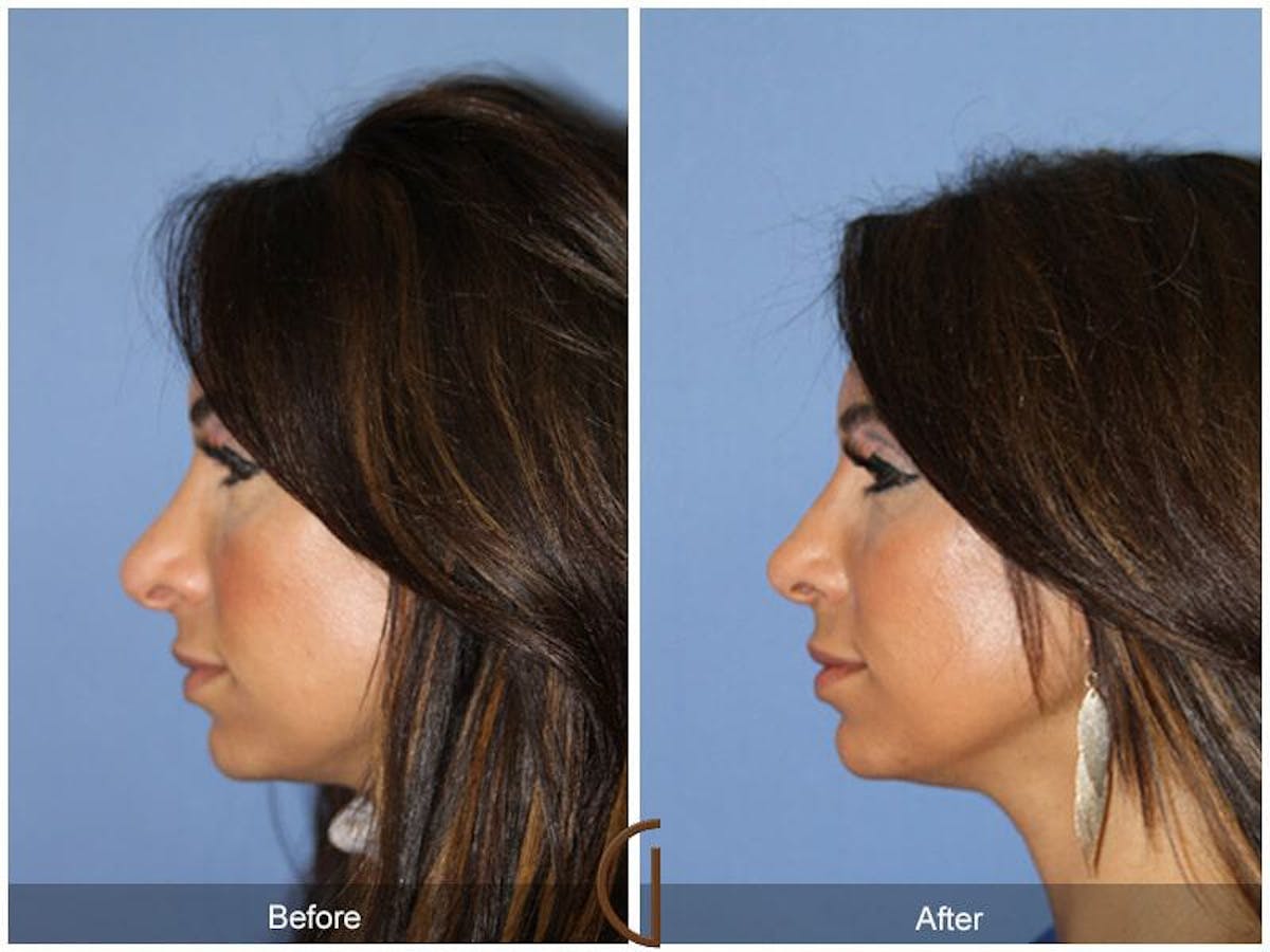 Ethnic Rhinoplasty Before & After Gallery - Patient 369106 - Image 1