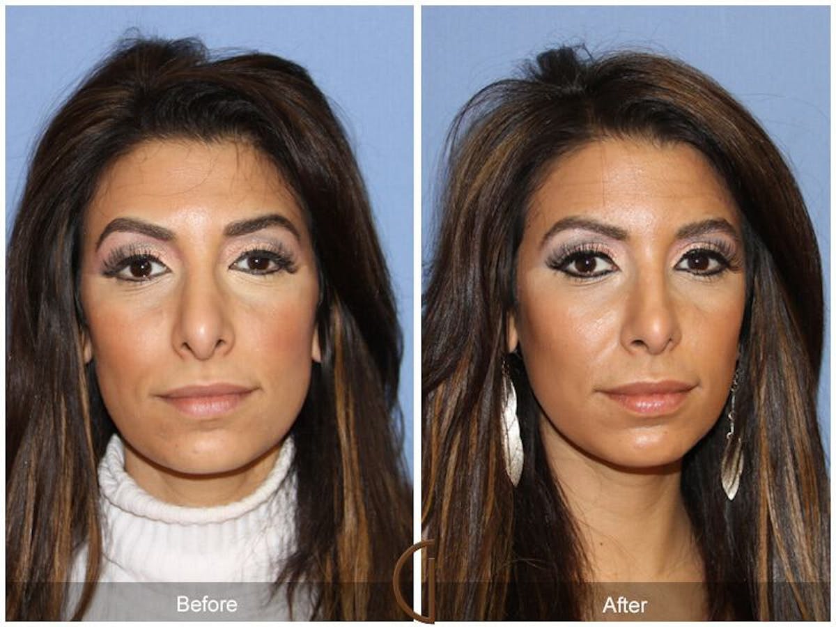 Ethnic Rhinoplasty Before & After Gallery - Patient 369106 - Image 2