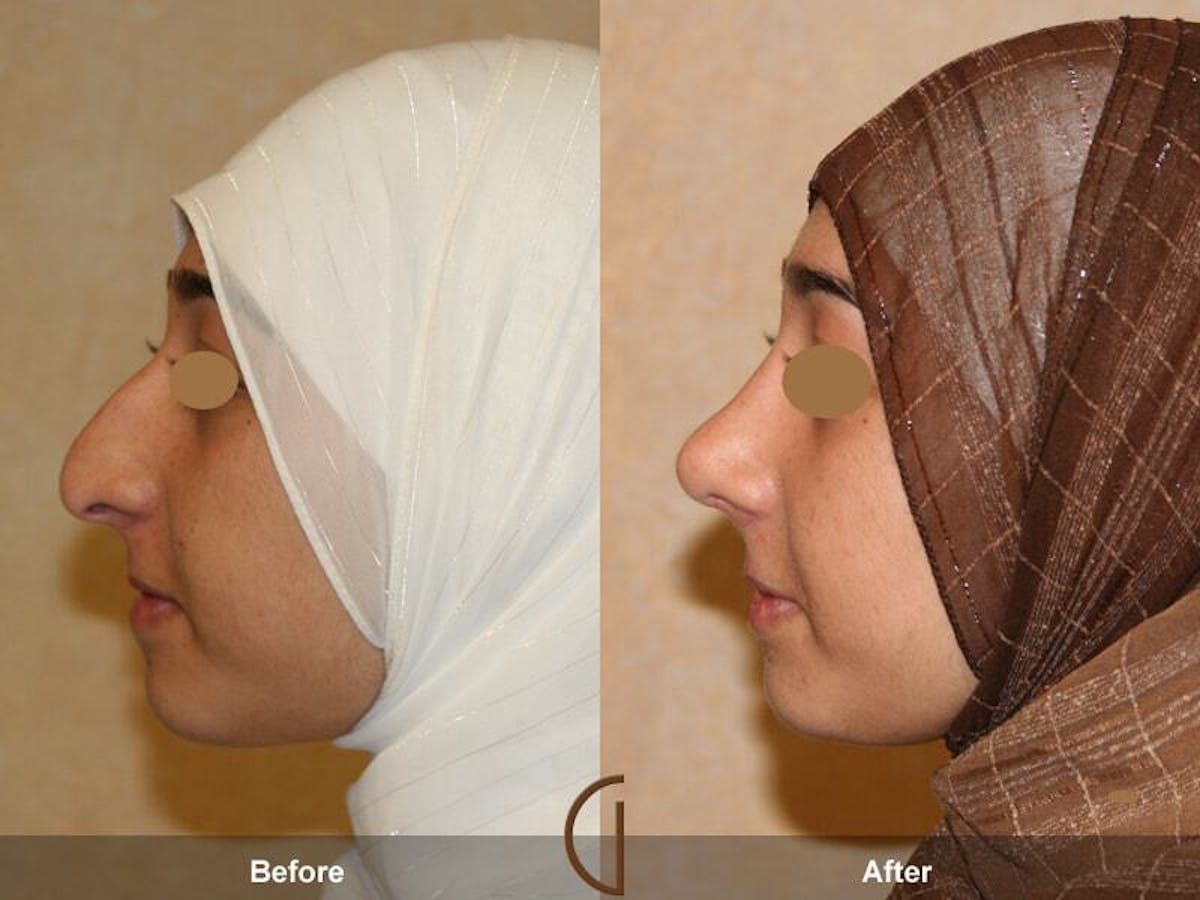 Ethnic Rhinoplasty Before & After Gallery - Patient 364518 - Image 1