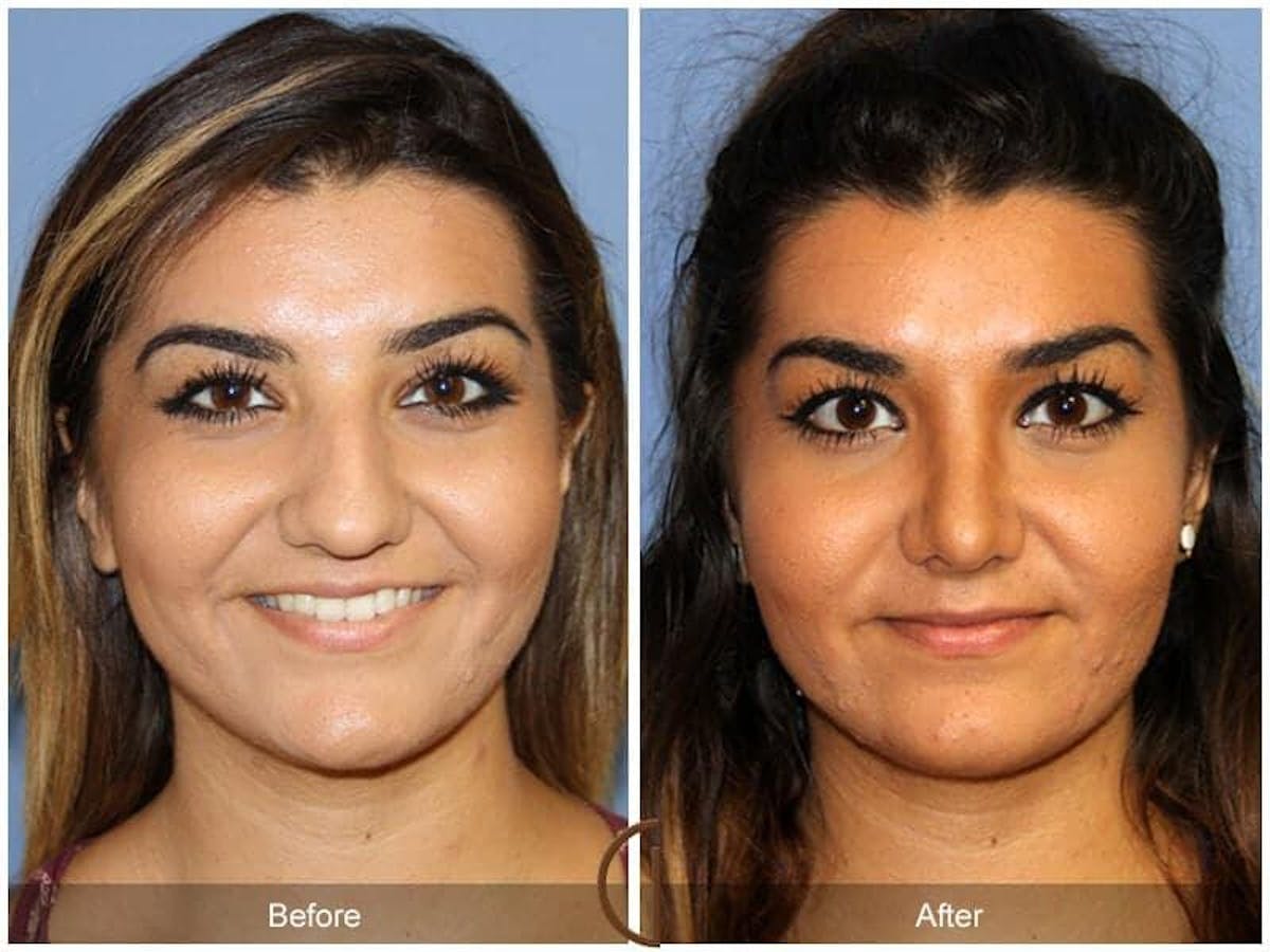 Ethnic Rhinoplasty Before & After Gallery - Patient 263623 - Image 2