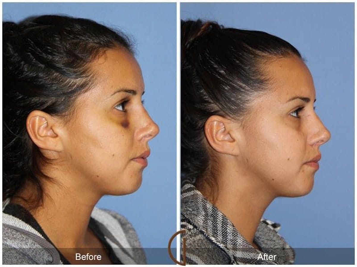 Revision Rhinoplasty Before & After Gallery - Patient 718744 - Image 3