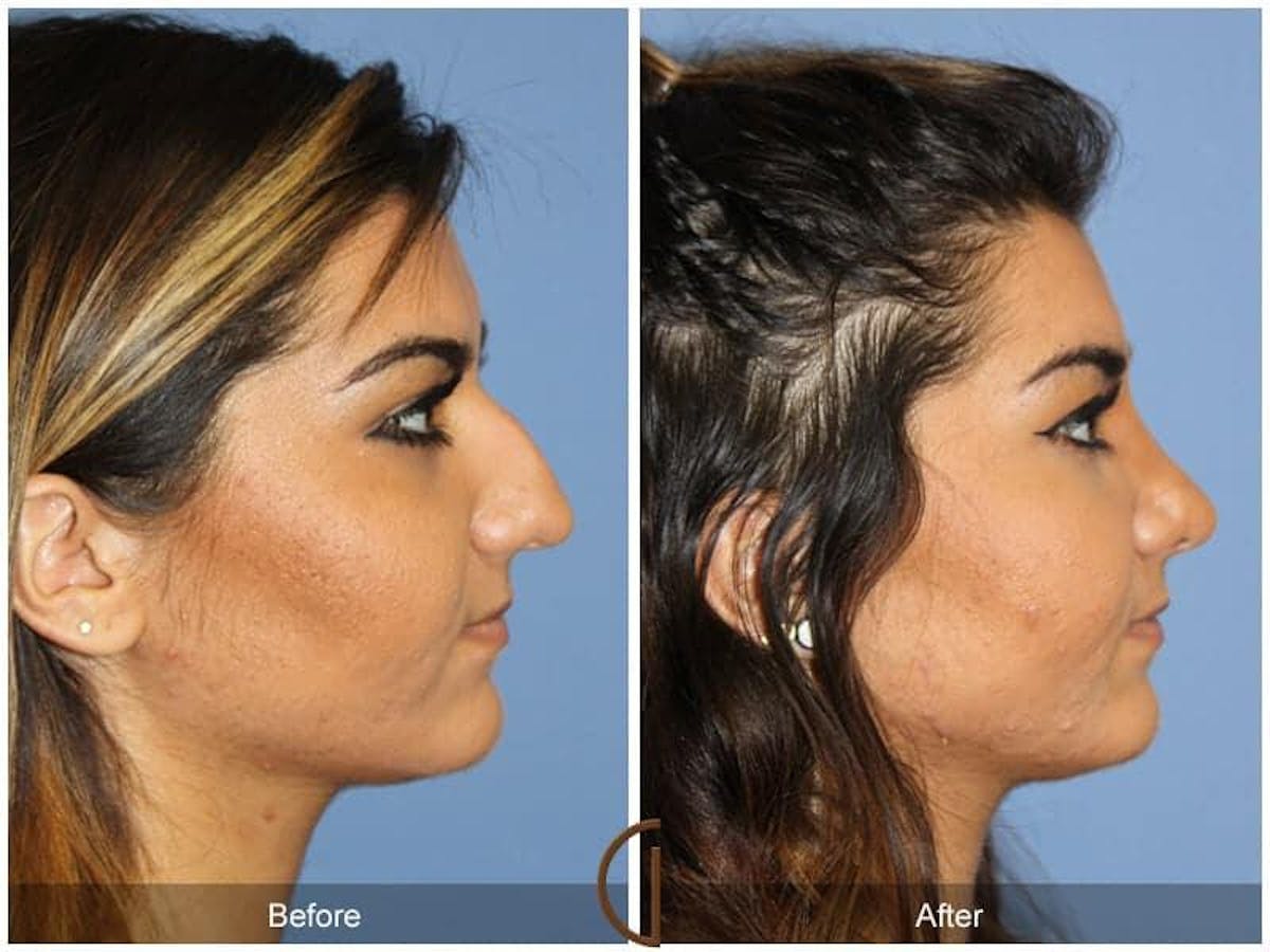 Ethnic Rhinoplasty Before & After Gallery - Patient 263623 - Image 3