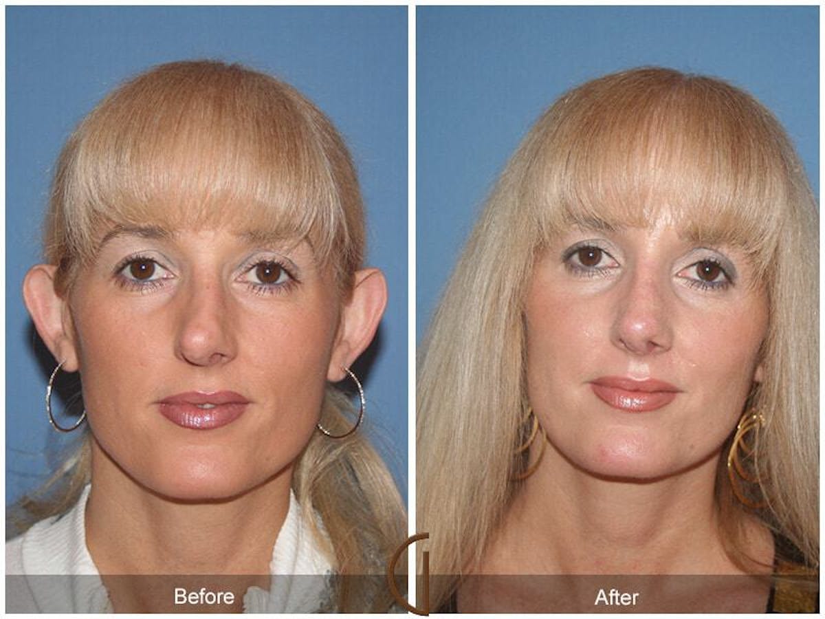 Revision Rhinoplasty Before & After Gallery - Patient 403392 - Image 2