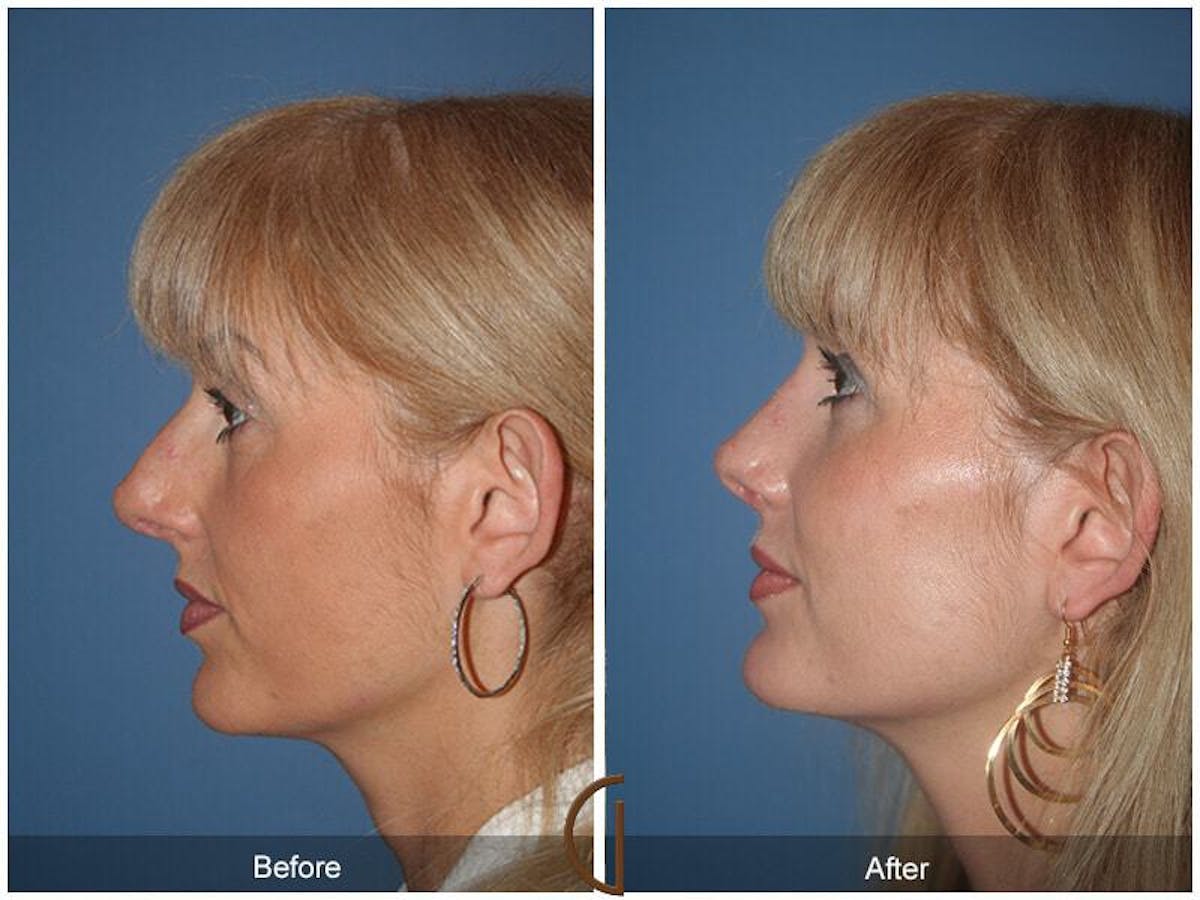 Revision Rhinoplasty Before & After Gallery - Patient 403392 - Image 1