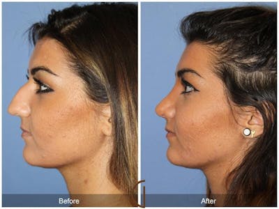 Rhinoplasty Before & After Gallery - Patient 257375 - Image 1